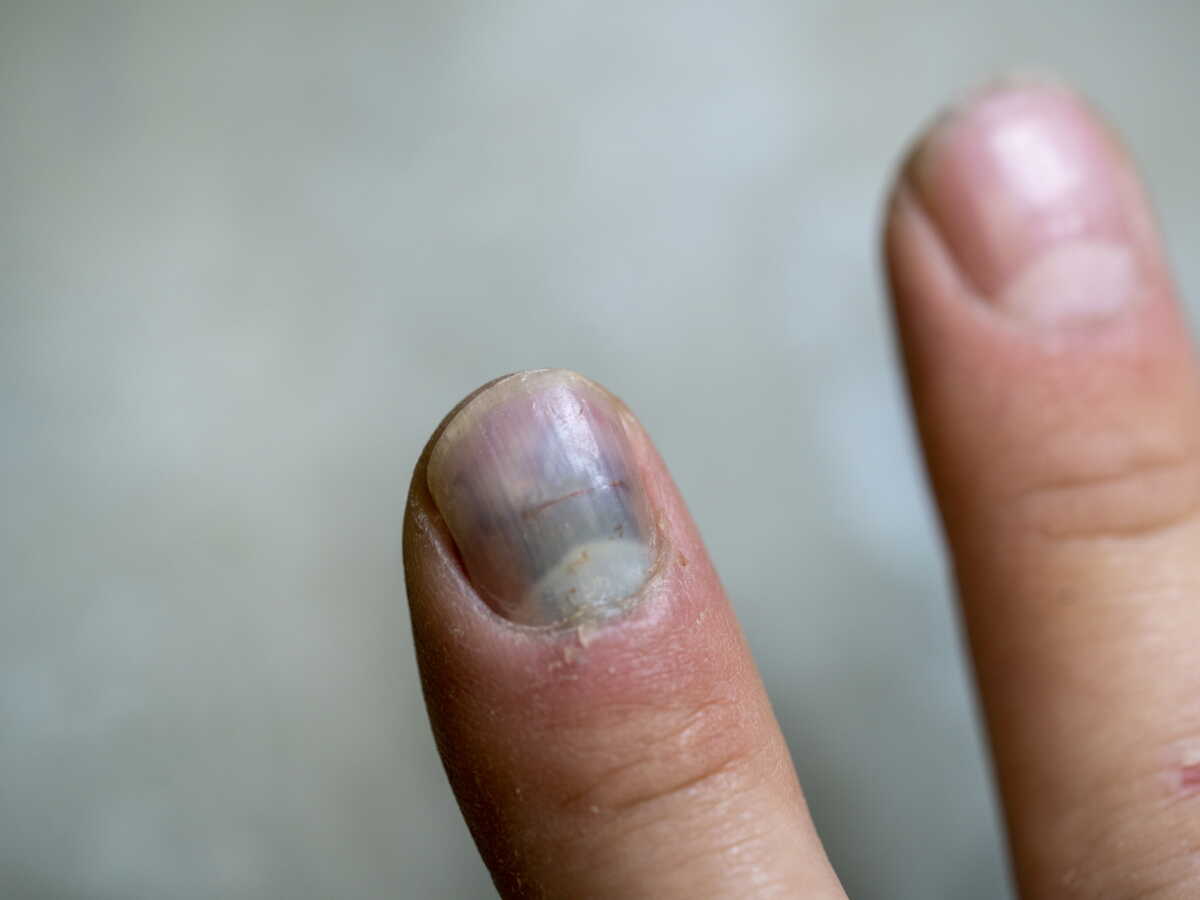 Trait noir sur les ongles : reconnaître les causes et les signes d’alerte