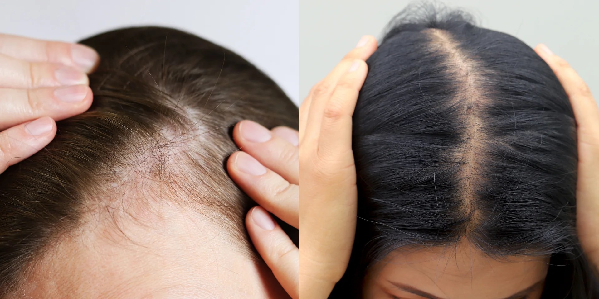 Femme et perte de cheveux : reconnaître le type de chute, ses causes et le bon traitement
